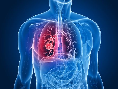 Se suma SESA a la conmemoración del Día Internacional de Lucha contra el Cáncer de Pulmón