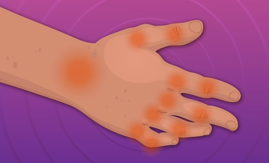 Emite SESA recomendaciones para pacientes con artritis reumatoide