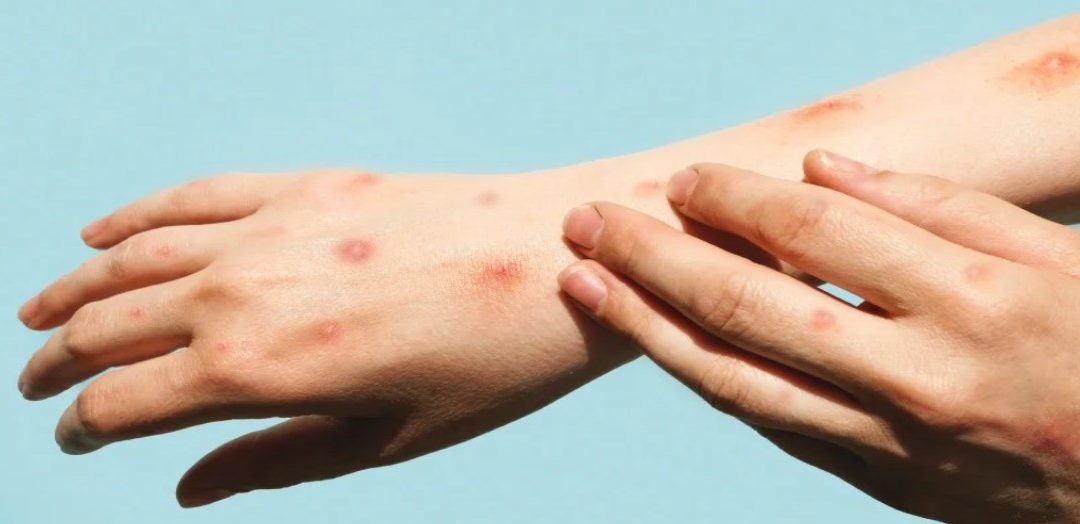 Realiza SESA vigilancia epidemiológica de viruela símica