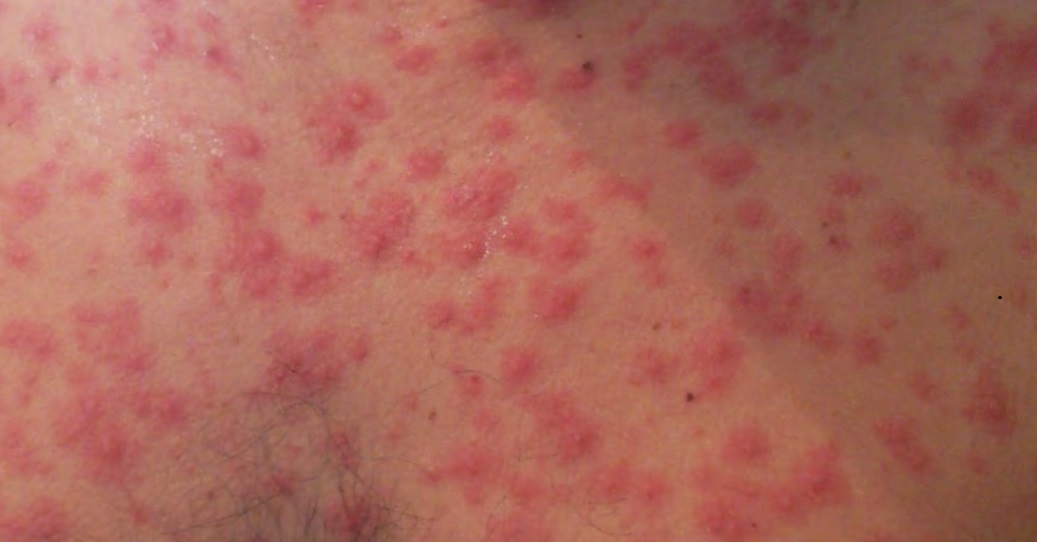 Realiza SESA vigilancia epidemiológica de viruela símica en el estado