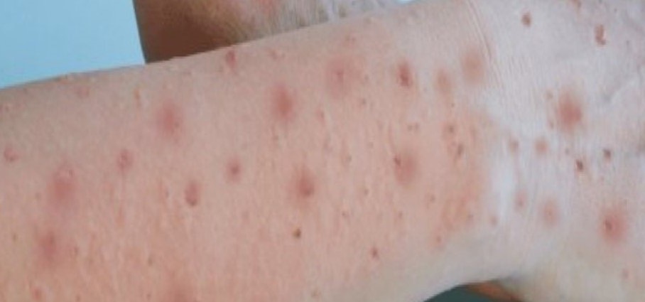 SESA mantiene vigilancia epidemiológica de viruela símica en el estado