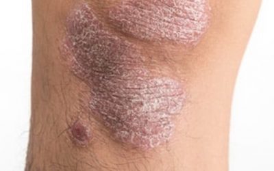 Se une SESA a la conmemoración del Día Mundial de la Psoriasis